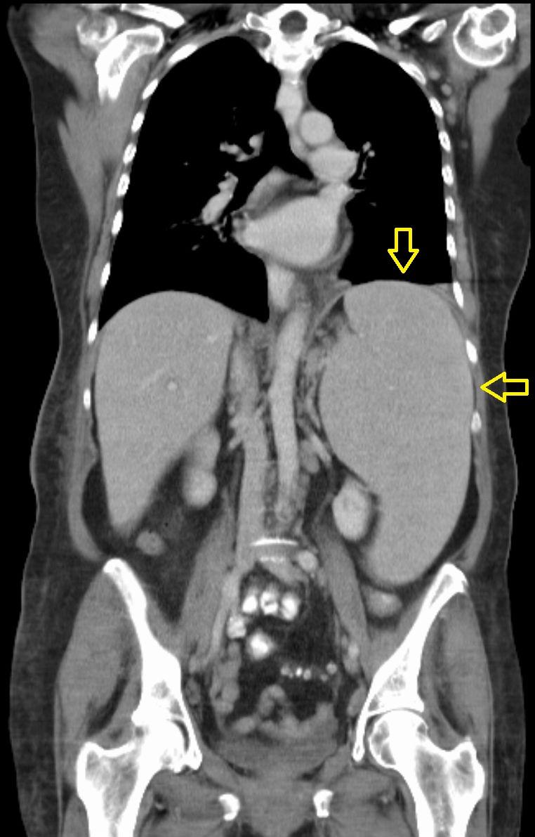 Splenomegaly - Wikipedia