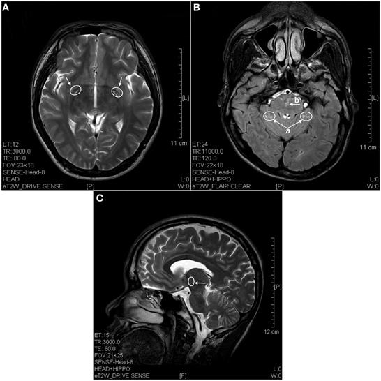 Olney's lesions - Wikipedia