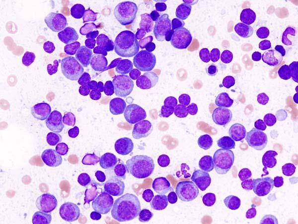 Multiple myeloma - Wikipedia