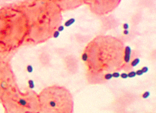 Sputum - Wikipedia