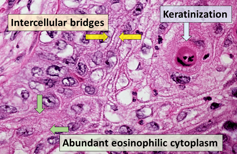 Squamous-cell carcinoma - Wikipedia