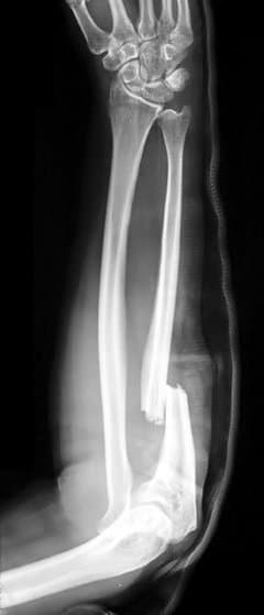 Monteggia fracture - Wikipedia