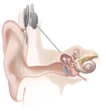 Neurostimulation — Wikipédia