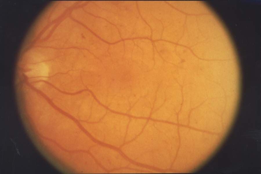 Retinopathy - Wikipedia