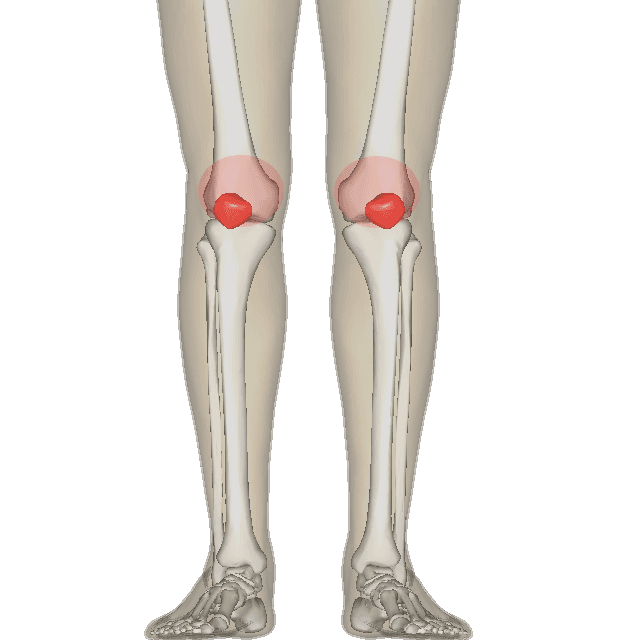 Patellofemoral pain syndrome - Wikipedia