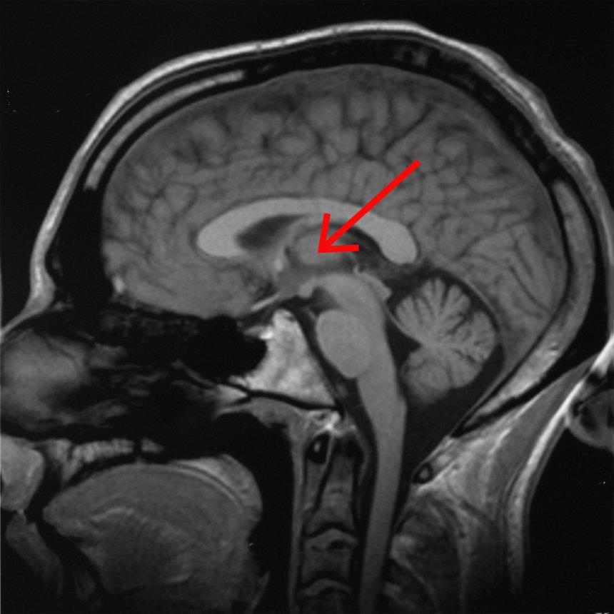 Thalamus - Wikipedia