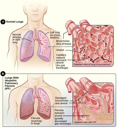 Idiopathic pulmonary fibrosis - Wikipedia