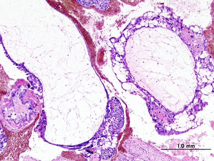 Molar pregnancy - Wikipedia
