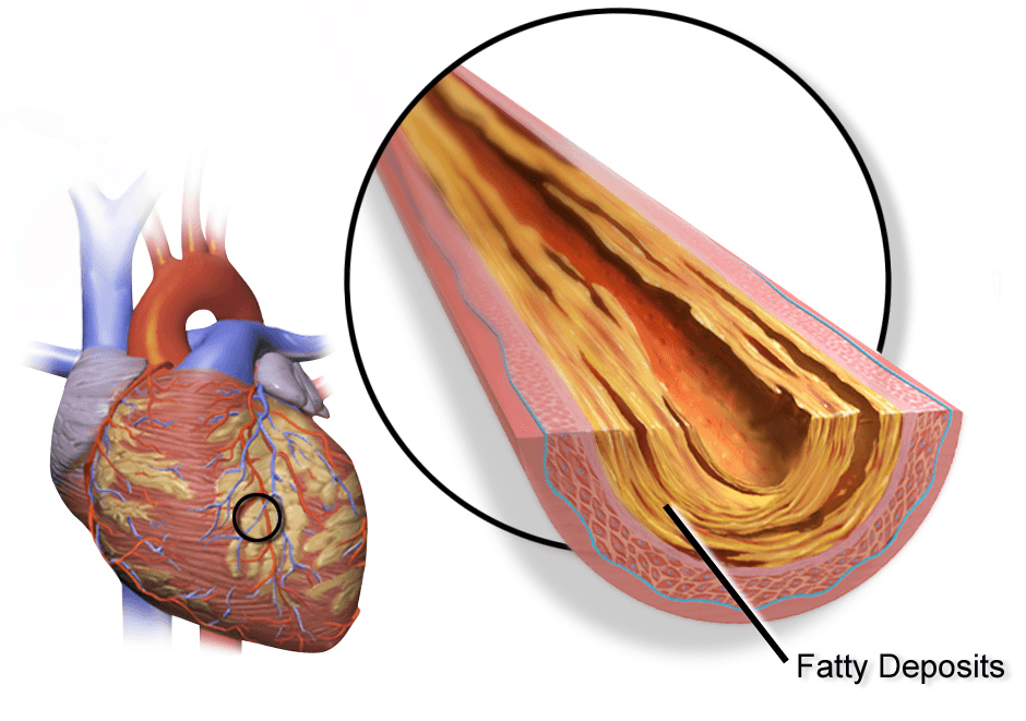 Coronary artery disease - Wikipedia