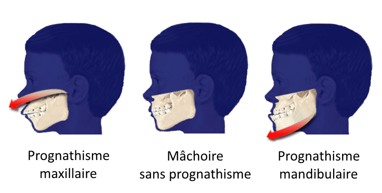 Prognathisme — Wikipédia