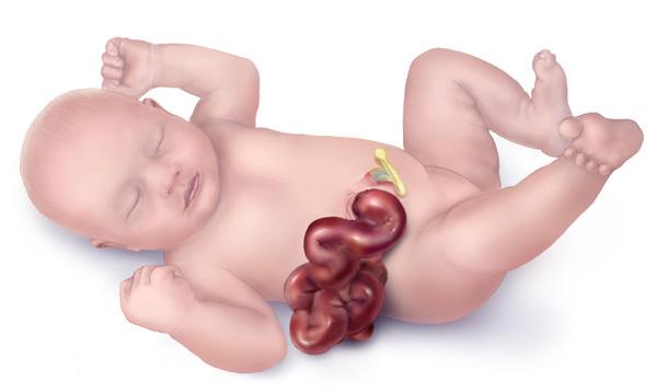 Gastroschisis - Wikipedia