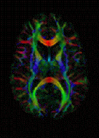 Diffusion-weighted magnetic resonance imaging - Wikipedia