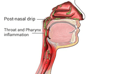 Écoulement post-nasal — Wikipédia