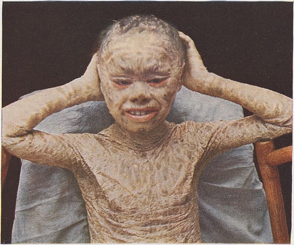 Lamellar ichthyosis - Wikipedia