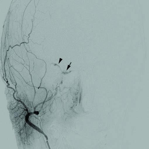 Maladie neurovasculaire — Wikipédia