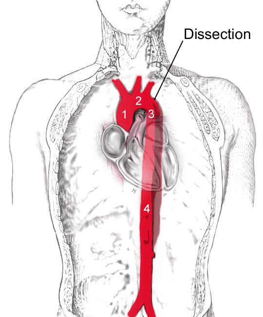 Aortic dissection - Wikipedia