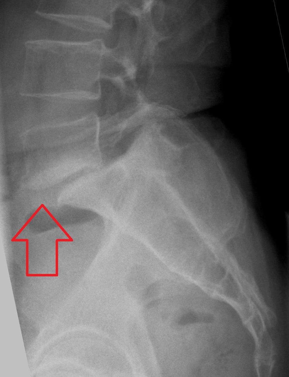 Spondylolisthesis - Wikipedia