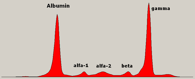 Gammapathie monoclonale — Wikipédia