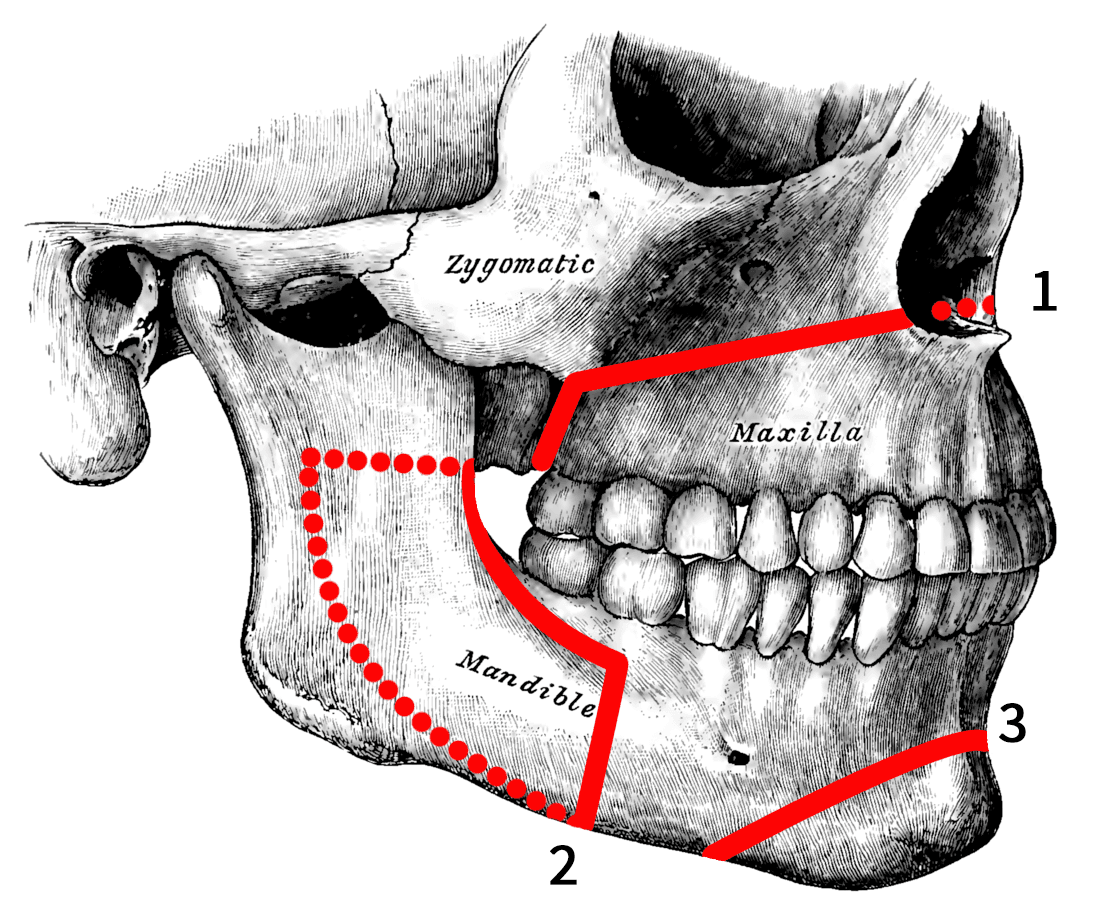 Orthognathic surgery - Wikipedia