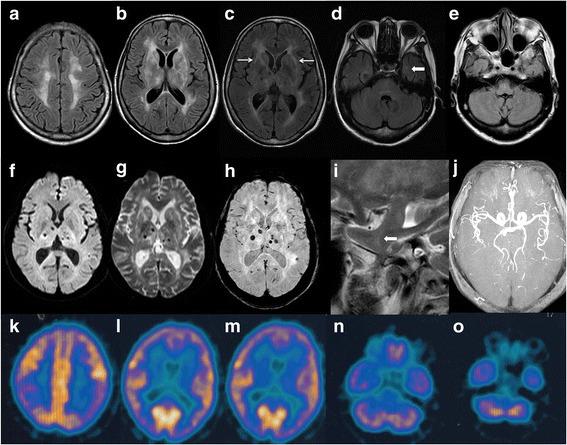 Fatal insomnia - Wikipedia