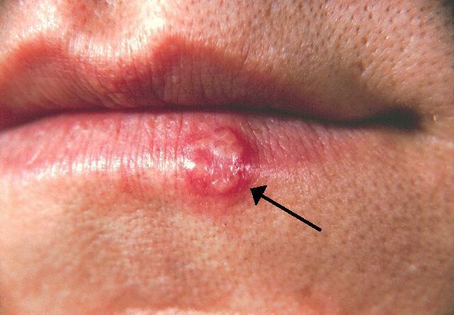 Cold sore - Wikipedia