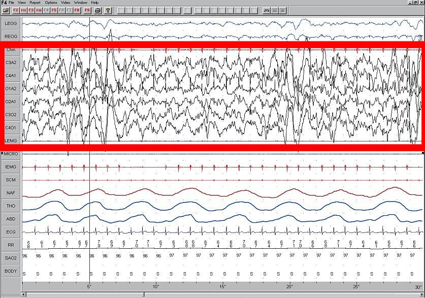 Delta wave - Wikipedia