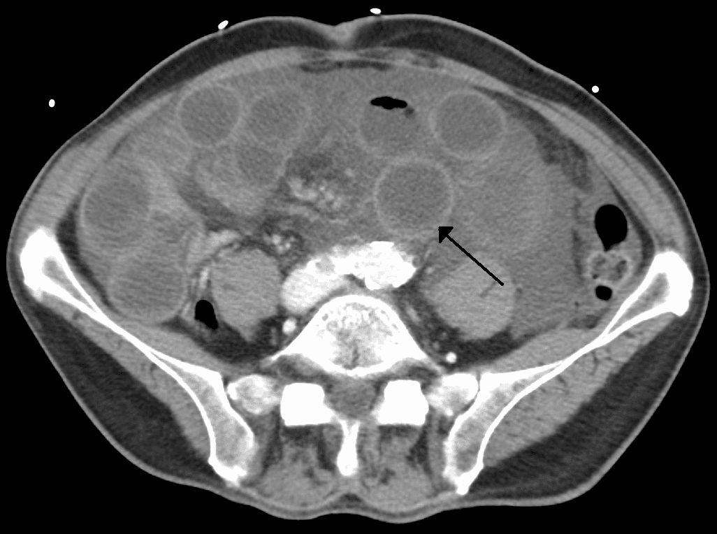 Intestinal ischemia - Wikipedia