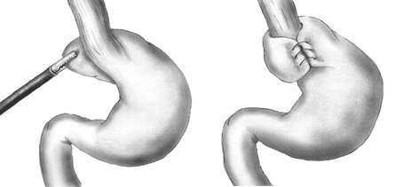 Nissen fundoplication - Wikipedia