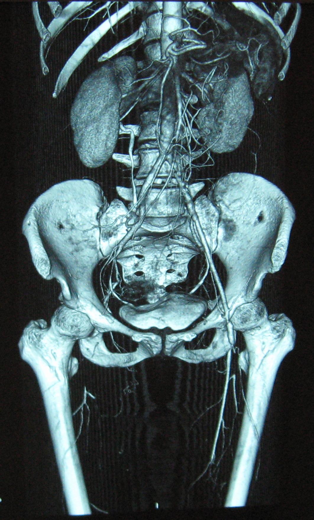 Thromboangiitis obliterans - Wikipedia