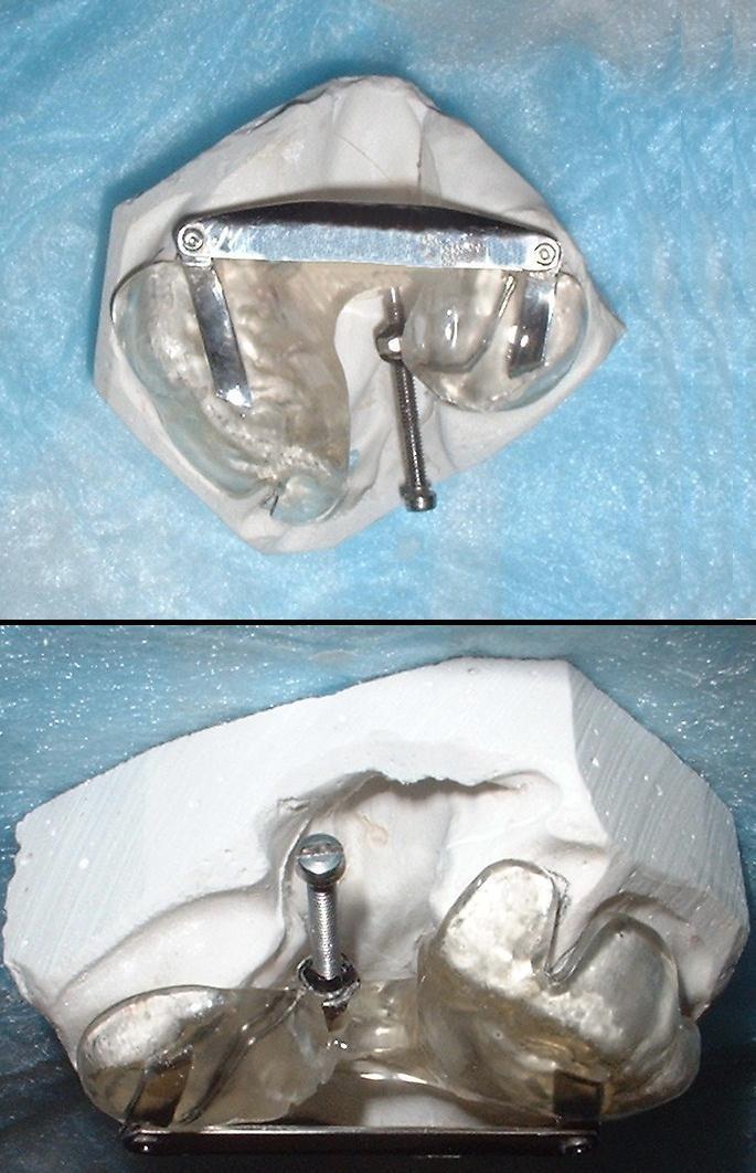 Palatal obturator - Wikipedia