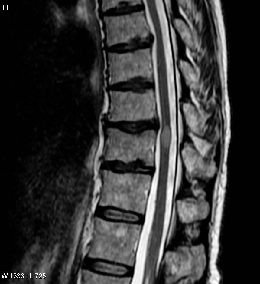 Transverse myelitis - Wikipedia