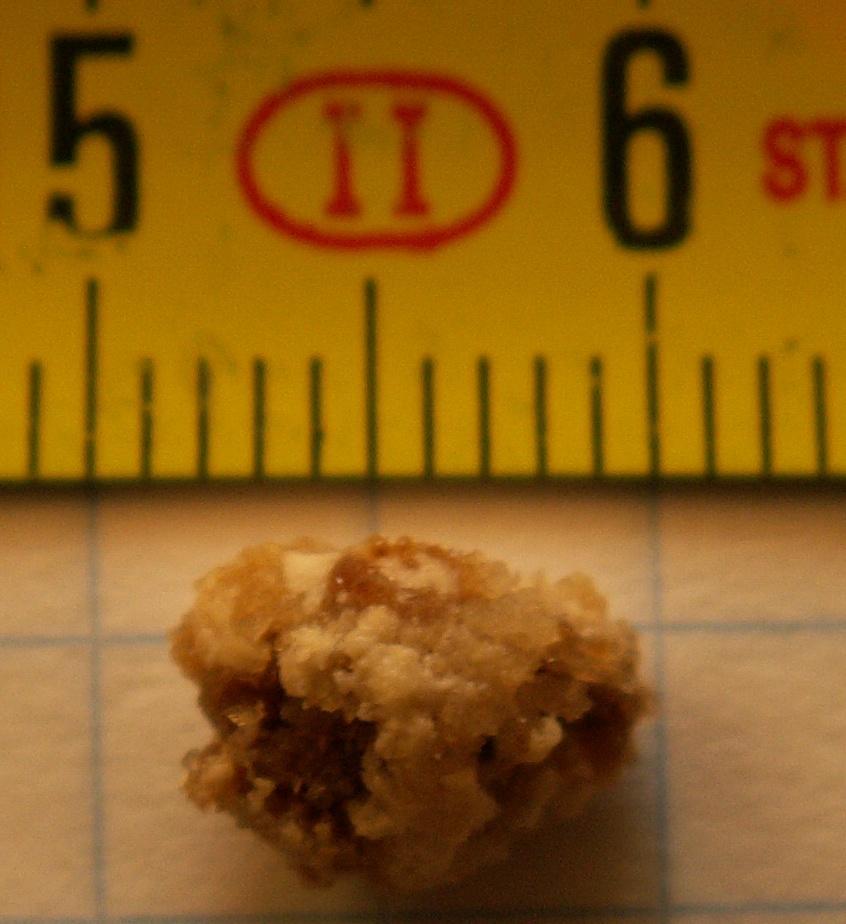 Kidney stone disease - Wikipedia