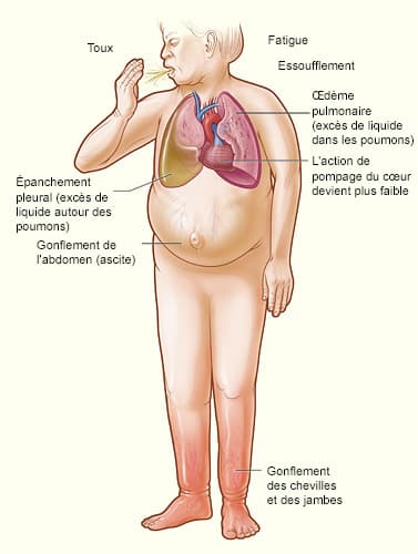 Insuffisance cardiaque chez l'humain — Wikipédia