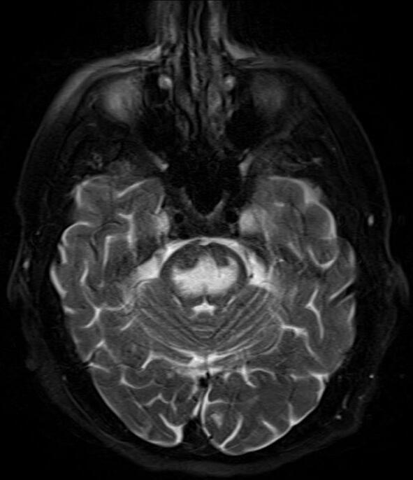Central pontine myelinolysis - Wikipedia