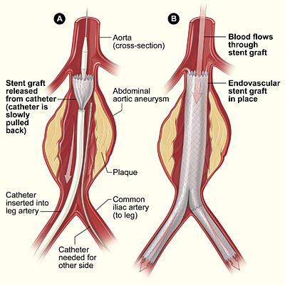 Endovascular aneurysm repair - Wikipedia