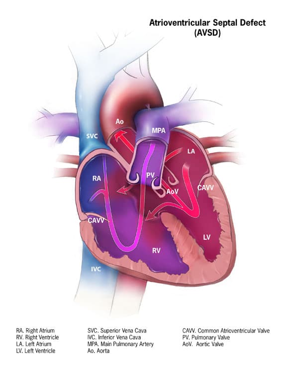 Atrioventricular septal defect - Wikipedia