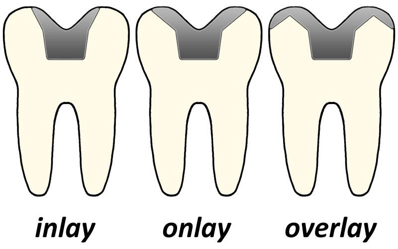 Inlays and onlays - Wikipedia