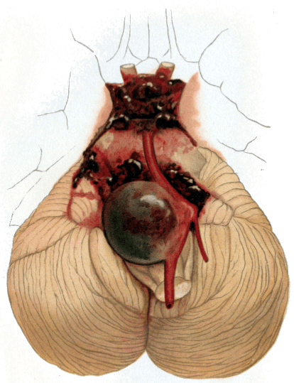 Intracranial aneurysm - Wikipedia