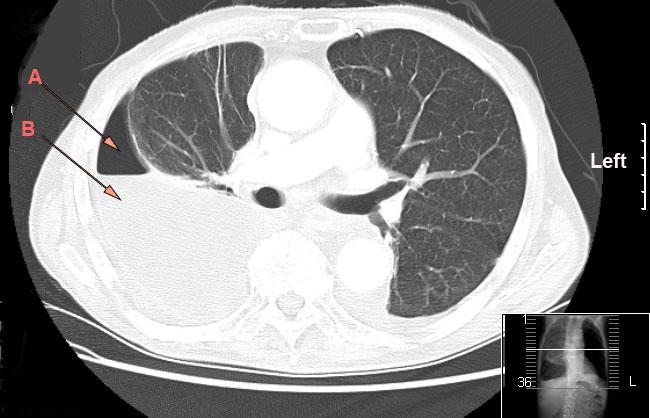 Pleural empyema - Wikipedia