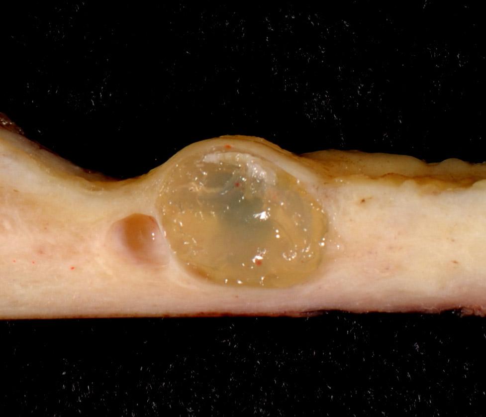 Nabothian cyst - Wikipedia