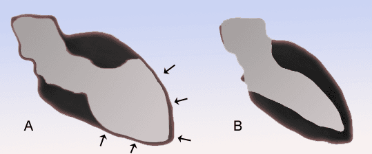 Syndrome de tako-tsubo — Wikipédia