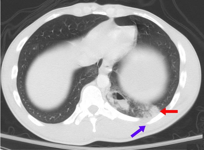 Asymptomatic - Wikipedia