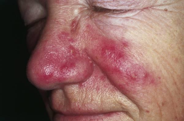 Rosacea - Wikipedia