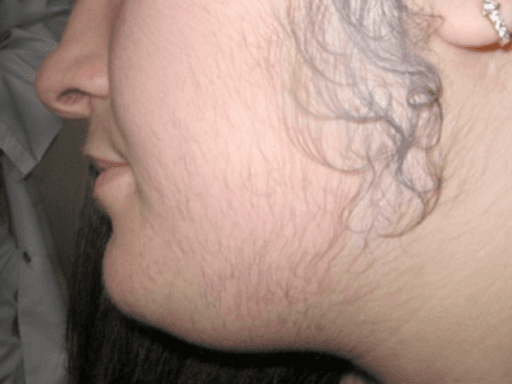 Hirsutism - Wikipedia