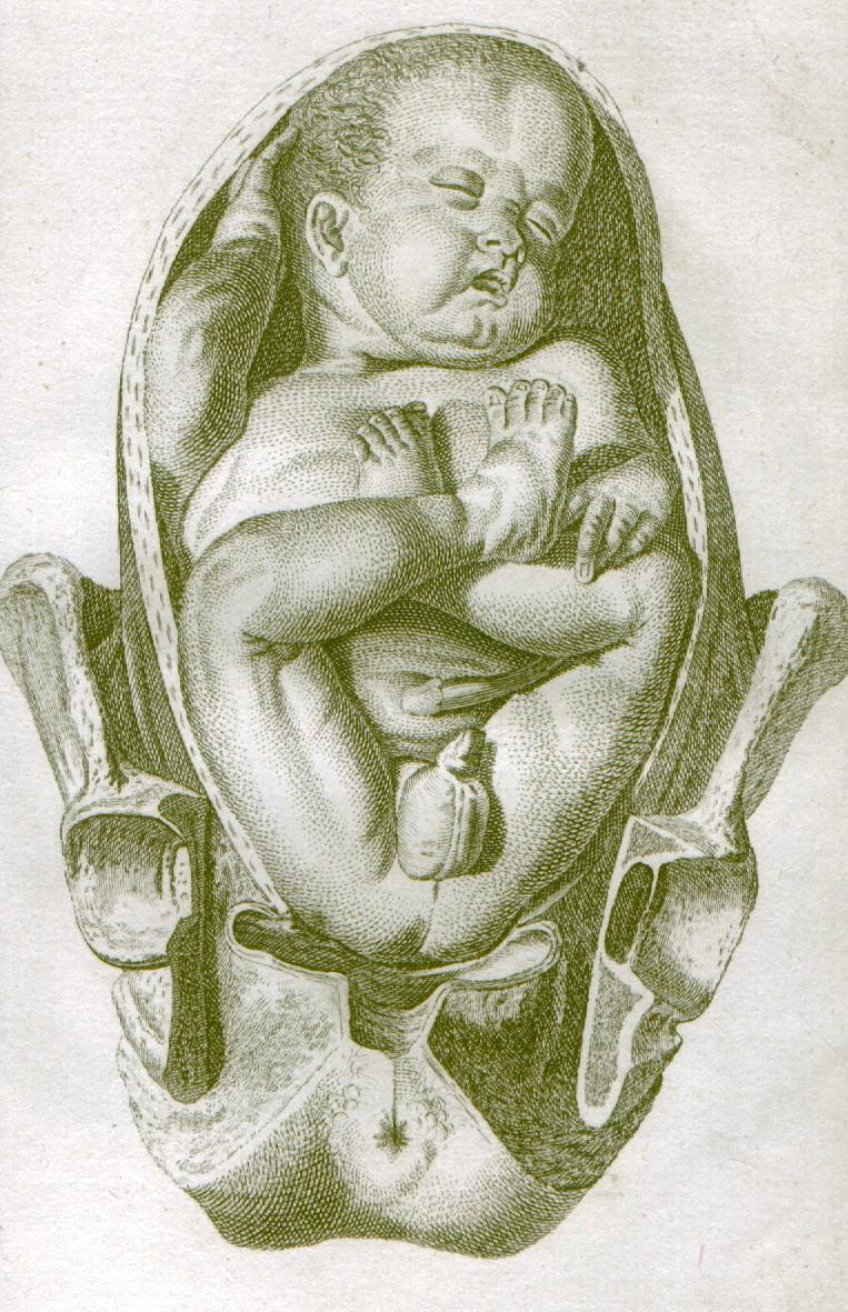 Breech birth - Wikipedia