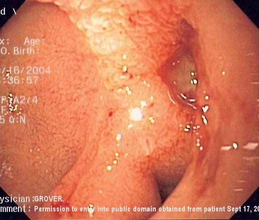 Upper gastrointestinal bleeding - Wikipedia