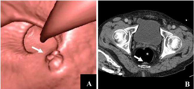 Virtual colonoscopy - Wikipedia