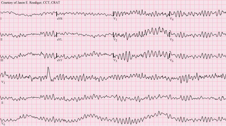 Fibrillation ventriculaire — Wikipédia