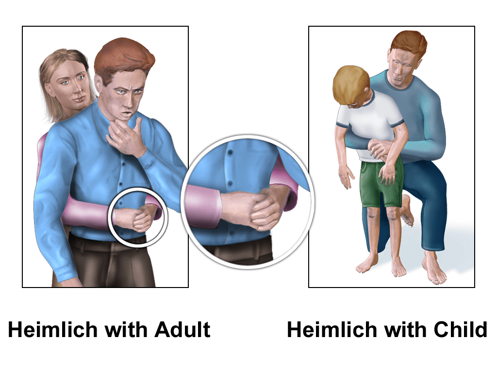 Méthode de Heimlich — Wikipédia