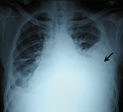 Hemothorax - Wikipedia